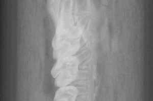 x-ray image of a mandible