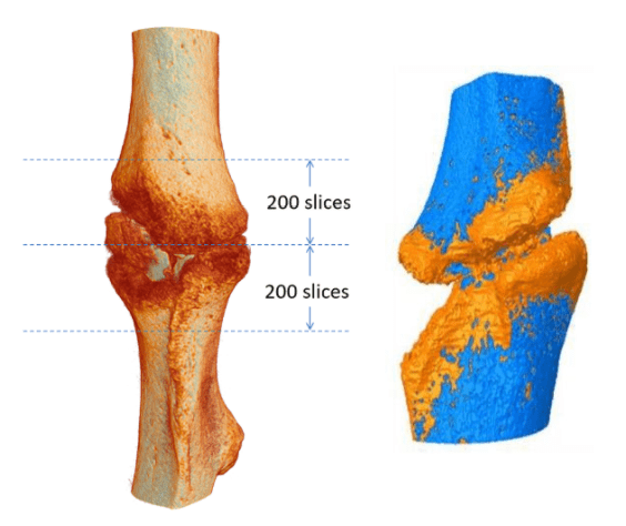 Bone fracture