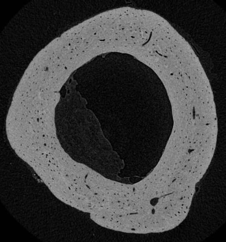 Bone strain
