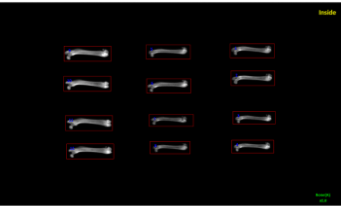 DEXA bone multiple measurement