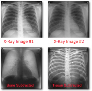 DEXA X-ray images